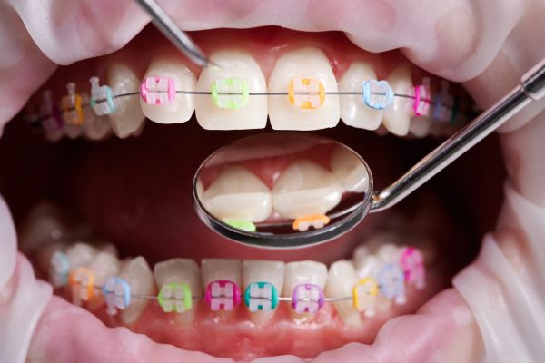 Bonding of brackets